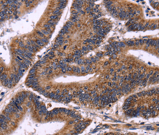 Immunohistochemistry of paraffin-embedded Human colon cancer using AMIGO2 Polyclonal Antibody at dilution of 1:50