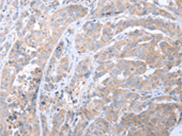 Immunohistochemistry of paraffin-embedded Human breast cancer tissue  using ATG16L1 Polyclonal Antibody at dilution of 1:40(?200)