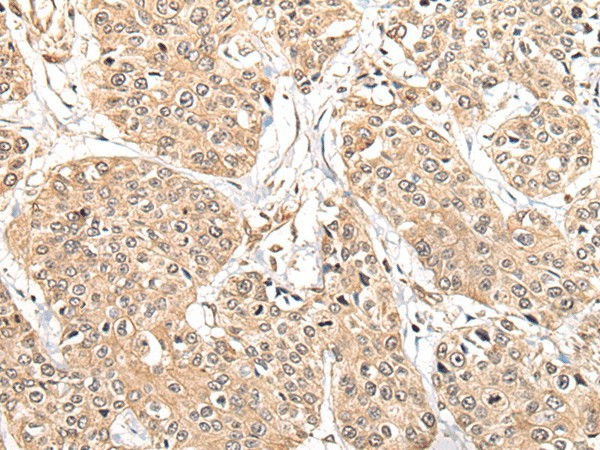 Immunohistochemistry of paraffin-embedded Human prost at e cancer tissue  using ATL3 Polyclonal Antibody at dilution of 1:85(?200)