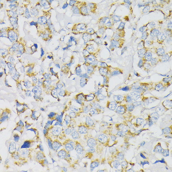 Immunohistochemistry of paraffin-embedded Human breast cancer using ATP5J Polyclonal Antibody at dilution of  1:100 (40x lens).