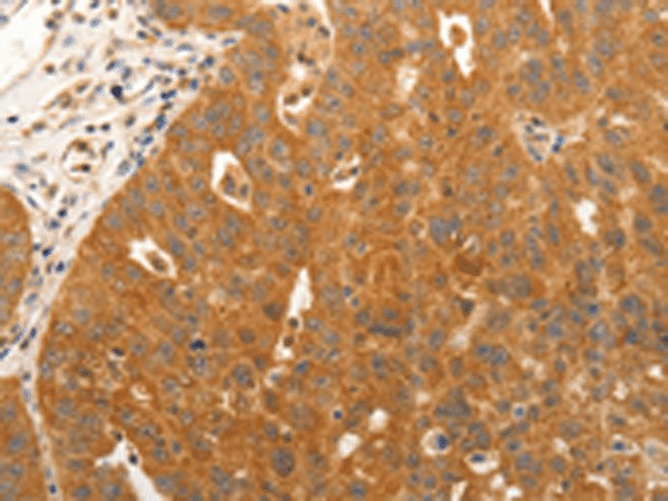 Immunohistochemistry of paraffin-embedded Human ovarian cancer tissue  using CDH5 Polyclonal Antibody at dilution of 1:30(?200)