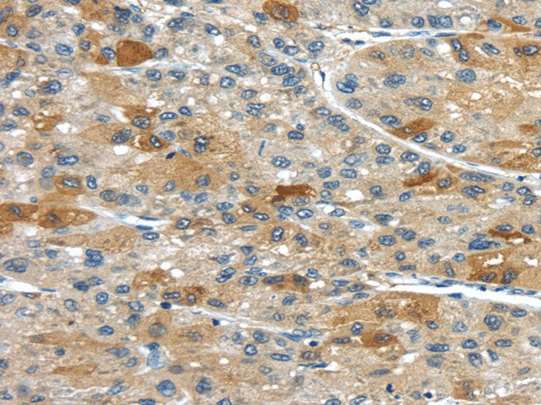 Immunohistochemistry of paraffin-embedded Human liver cancer using UPP2 Polyclonal Antibody at dilution of  1/35