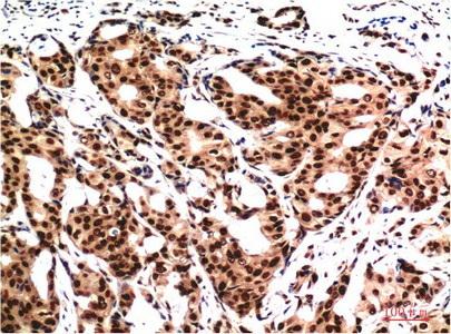 Immunohistochemistry of paraffin-embedded Human breast carcinoma tissue using Ubiquitin Monoclonal Antibody at dilution of 1:200.