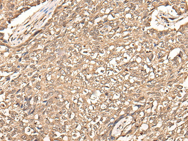 Immunohistochemistry of paraffin-embedded Human lung cancer tissue  using USP21 Polyclonal Antibody at dilution of 1:50(?200)