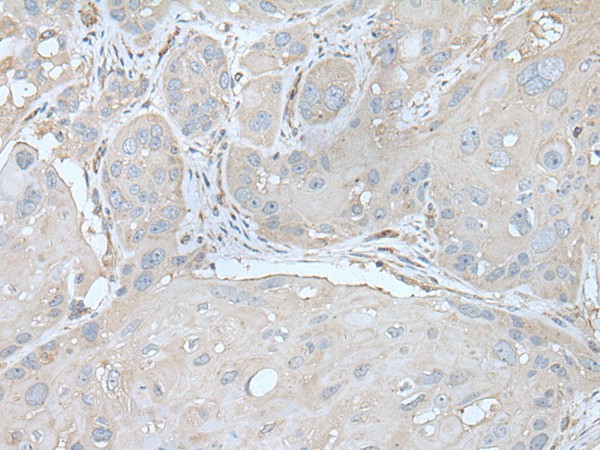 Immunohistochemistry of paraffin-embedded Human esophagus cancer tissue  using USO1 Polyclonal Antibody at dilution of 1:30(?200)