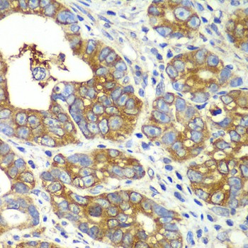 Immunohistochemistry of paraffin-embedded Human gastric cancer using QARS Polyclonal Antibody at dilution of 1:100 (40x lens).