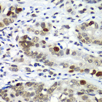 Immunohistochemistry of paraffin-embedded Human gastric cancer using DR1 Polyclonal Antibody at dilution of 1:100 (40x lens).