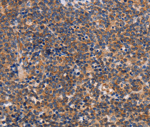 Immunohistochemistry of paraffin-embedded Human lymphoma tissue using ALG9 Polyclonal Antibody at dilution 1:30