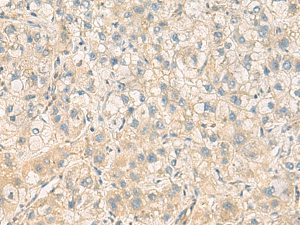 Immunohistochemistry of paraffin-embedded Human liver cancer tissue  using PPM1M Polyclonal Antibody at dilution of 1:100(?200)