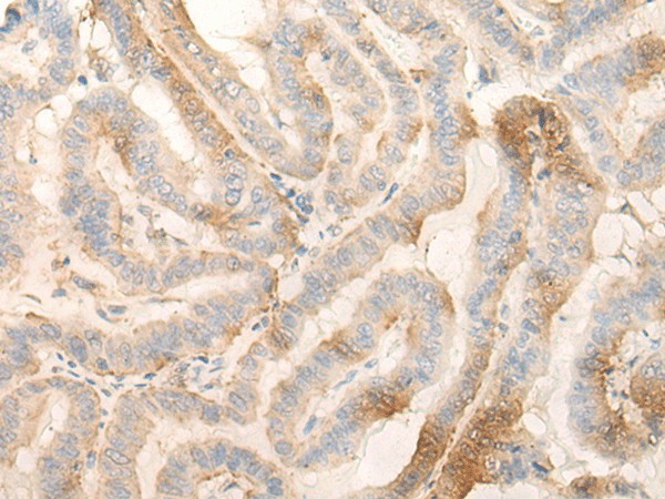 Immunohistochemistry of paraffin-embedded Human thyroid cancer tissue  using MPPED2 Polyclonal Antibody at dilution of 1:30(?200)