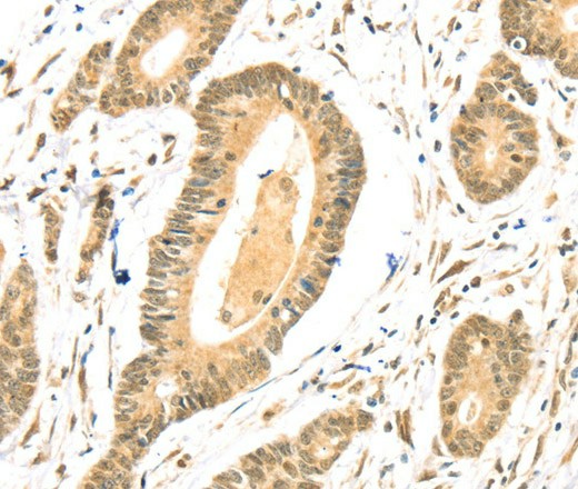 Immunohistochemistry of paraffin-embedded Human colon cancer using TSPAN13 Polyclonal Antibody at dilution of 1:35