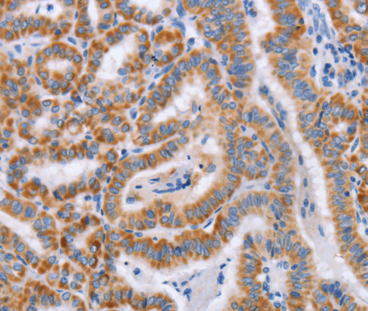 Immunohistochemistry of paraffin-embedded Human thyroid cancer tissue using BST1 Polyclonal Antibody at dilution 1:50