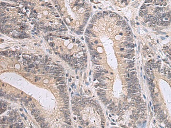 Immunohistochemistry of paraffin-embedded Human gastric cancer tissue  using PPM1K Polyclonal Antibody at dilution of 1:55(?200)