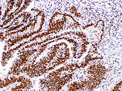 Immunohistochemistry of paraffinembedded Human colon cancer tissue with MutS Protein Homolog 2(MSH2) Monoclonal Antibody(Antigen repaired by EDTA).