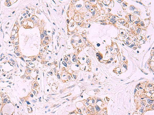 Immunohistochemistry of paraffin-embedded Human gastric cancer tissue  using TNF Polyclonal Antibody at dilution of 1:40(?200)