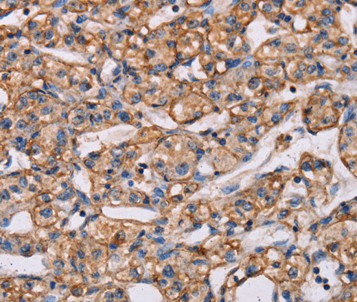 Immunohistochemistry of paraffin-embedded Human prostate cancer tissue using ARAP1 Polyclonal Antibody at dilution 1:40