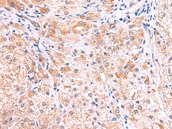 Immunohistochemistry of paraffin-embedded Human liver cancer tissue  using SMPD2 Polyclonal Antibody at dilution of 1:70(?200)