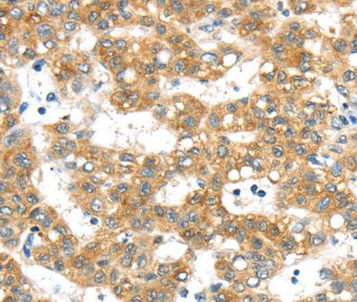 Immunohistochemistry of paraffin-embedded Human cervical cancer tissue using PTPN4 Polyclonal Antibody at dilution 1:40