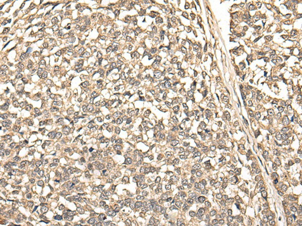 Immunohistochemistry of paraffin-embedded Human esophagus cancer tissue  using BUD31 Polyclonal Antibody at dilution of 1:75(?200)