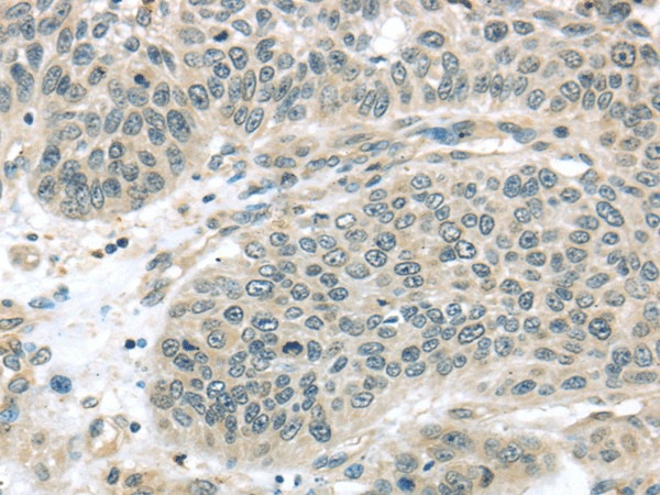 Immunohistochemistry of paraffin-embedded Human lung cancer using THAP4 Polyclonal Antibody at dilution of  1/30