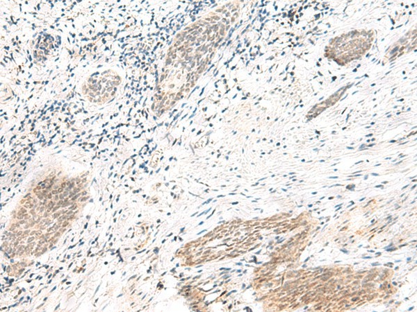 Immunohistochemistry of paraffin-embedded Human esophagus cancer tissue  using ARL2BP Polyclonal Antibody at dilution of 1:50(?200)