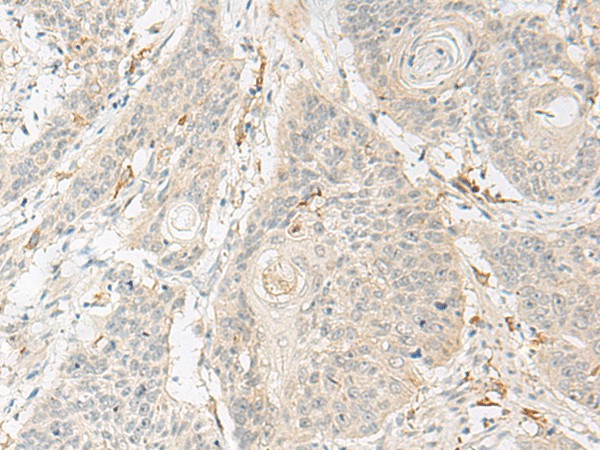 Immunohistochemistry of paraffin-embedded Human esophagus cancer tissue  using GNAT3 Polyclonal Antibody at dilution of 1:40(?200)