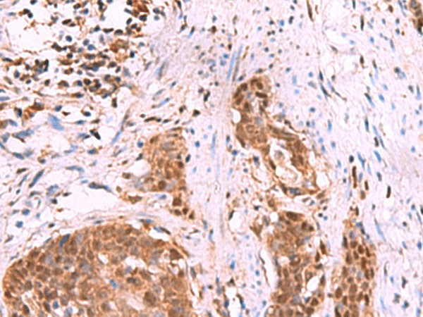 Immunohistochemistry of paraffin-embedded Human esophagus cancer tissue  using KATNAL1 Polyclonal Antibody at dilution of 1:80(?200)