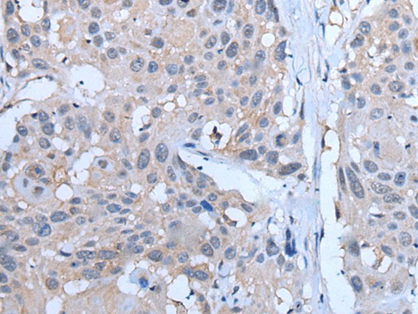 Immunohistochemistry of paraffin-embedded Human esophagus cancer tissue  using YPEL5 Polyclonal Antibody at dilution of 1:60(?200)