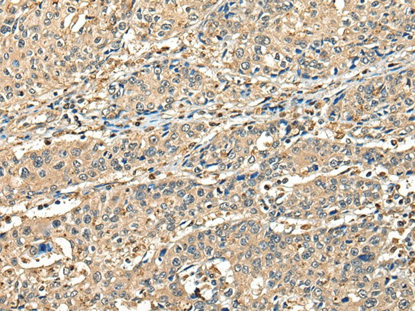 Immunohistochemistry of paraffin-embedded Human prost at e cancer tissue  using CCDC112 Polyclonal Antibody at dilution of 1:45(?200)