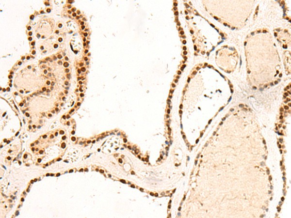 Immunohistochemistry of paraffin-embedded Human thyroid cancer tissue  using RMND5B Polyclonal Antibody at dilution of 1:50(?200)