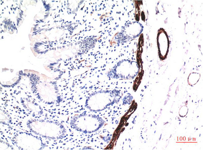 Immunohistochemistry of paraffin-embedded Human colon carcinoma tissue using ACTA1 Monoclonal Antibody at dilution of 1:200.