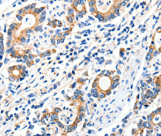 Immunohistochemistry of paraffin-embedded Human gasrtic cancer tissue using GluR2 Polyclonal Antibody at dilution 1:40