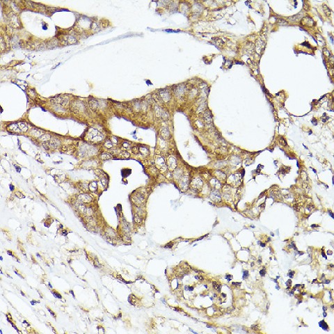 Immunohistochemistry of paraffin-embedded human colon carcinoma using ACC1 Polyclonal Antibody at dilution of 1:50 (40x lens).Perform high pressure antigen retrieval with 10 mM citrate buffer pH 6.0 before commencing with IHC staining protocol.