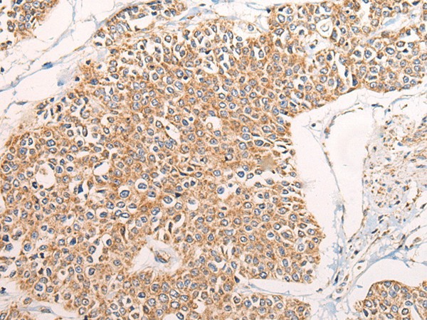 Immunohistochemistry of paraffin-embedded Human prost at e cancer tissue  using C14orf2 Polyclonal Antibody at dilution of 1:60(?200)