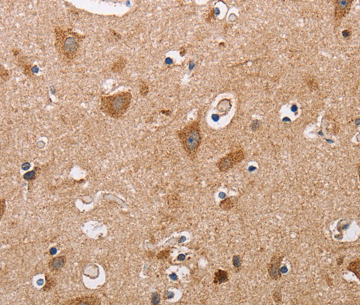 Immunohistochemistry of paraffin-embedded Human thyroid cancer tissue using ALG9 Polyclonal Antibody at dilution 1:60