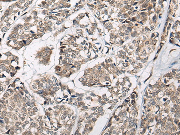 Immunohistochemistry of paraffin-embedded Human esophagus cancer tissue  using CACNB3 Polyclonal Antibody at dilution of 1:55(?200)