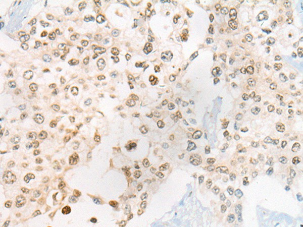 Immunohistochemistry of paraffin-embedded Human prost ate cancer tissue  using CEP72 Polyclonal Antibody at dilution of 1:40(?200)