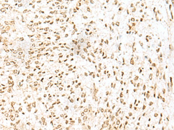 Immunohistochemistry of paraffin-embedded Human liver cancer tissue  using LYRM1 Polyclonal Antibody at dilution of 1:50(?200)