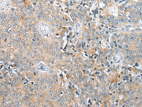 Immunohistochemistry of paraffin-embedded Human prost at e cancer tissue  using COMMD6 Polyclonal Antibody at dilution of 1:45(?200)