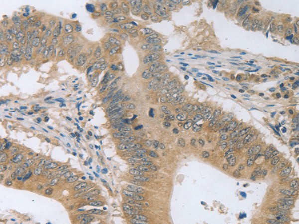 Immunohistochemistry of paraffin-embedded Human colon cancer tissue  using P2RY11 Polyclonal Antibody at dilution of 1:30(?200)