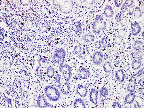 Immunohistochemistry of paraffinembedded Human gastric cancer tissue with Mast cell tryptase(MCT) Monoclonal Antibody(Antigen repaired by EDTA).