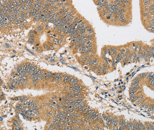 Immunohistochemistry of paraffin-embedded Human colon cancer tissue using ARHGAP15 Polyclonal Antibody at dilution 1:30