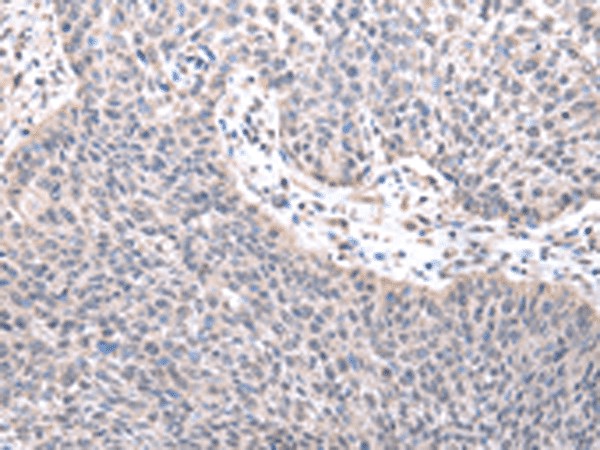 Immunohistochemistry of paraffin-embedded Human lung cancer tissue  using ZNF239 Polyclonal Antibody at dilution of 1:25(?200)