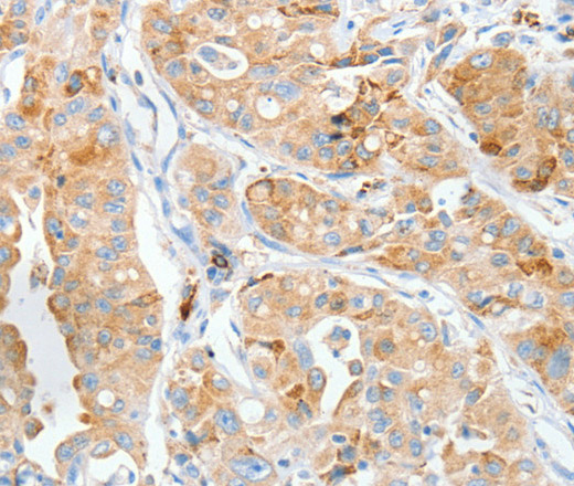 Immunohistochemistry of paraffin-embedded Human lung cancer tissue using MANF Polyclonal Antibody at dilution 1:50