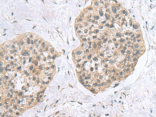 Immunohistochemistry of paraffin-embedded Human esophagus cancer tissue  using RPL18 Polyclonal Antibody at dilution of 1:60(?200)