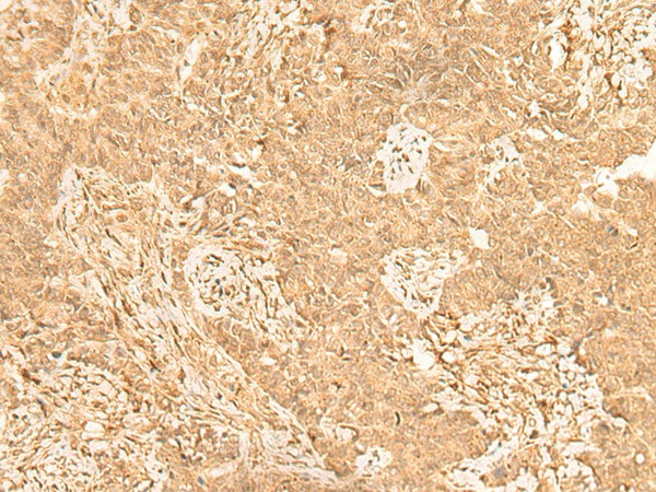 Immunohistochemistry of paraffin-embedded Human ovarian cancer tissue  using ST8SIA4 Polyclonal Antibody at dilution of 1:50(?200)