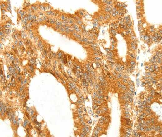 Immunohistochemistry of paraffin-embedded Human colon cancer using DIABLO Polyclonal Antibody at dilution of 1:50