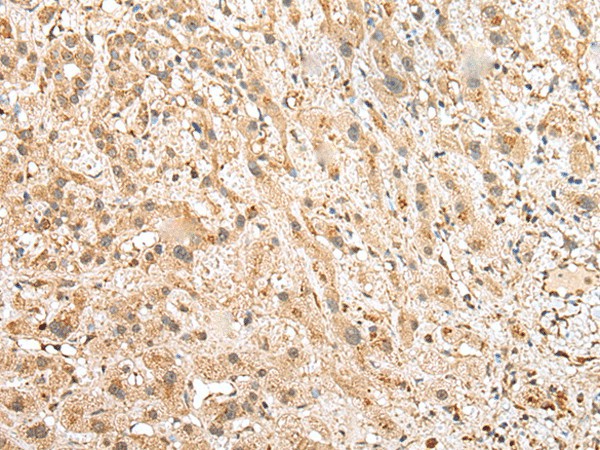 Immunohistochemistry of paraffin-embedded Human liver cancer tissue  using NUDT12 Polyclonal Antibody at dilution of 1:25(?200)