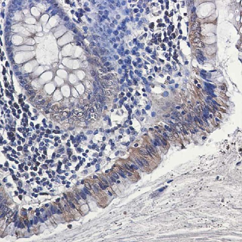 Immunohistochemistry of Osteopontin in paraffin-embedded Human colon cancer tissue using Osteopontin Rabbit mAb at dilution 1:50