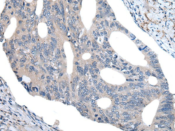 Immunohistochemistry of paraffin-embedded Human colorectal cancer tissue  using UBR4 Polyclonal Antibody at dilution of 1:55(?200)